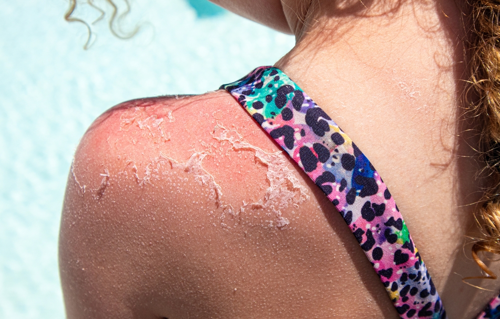 Sunburn Challenge